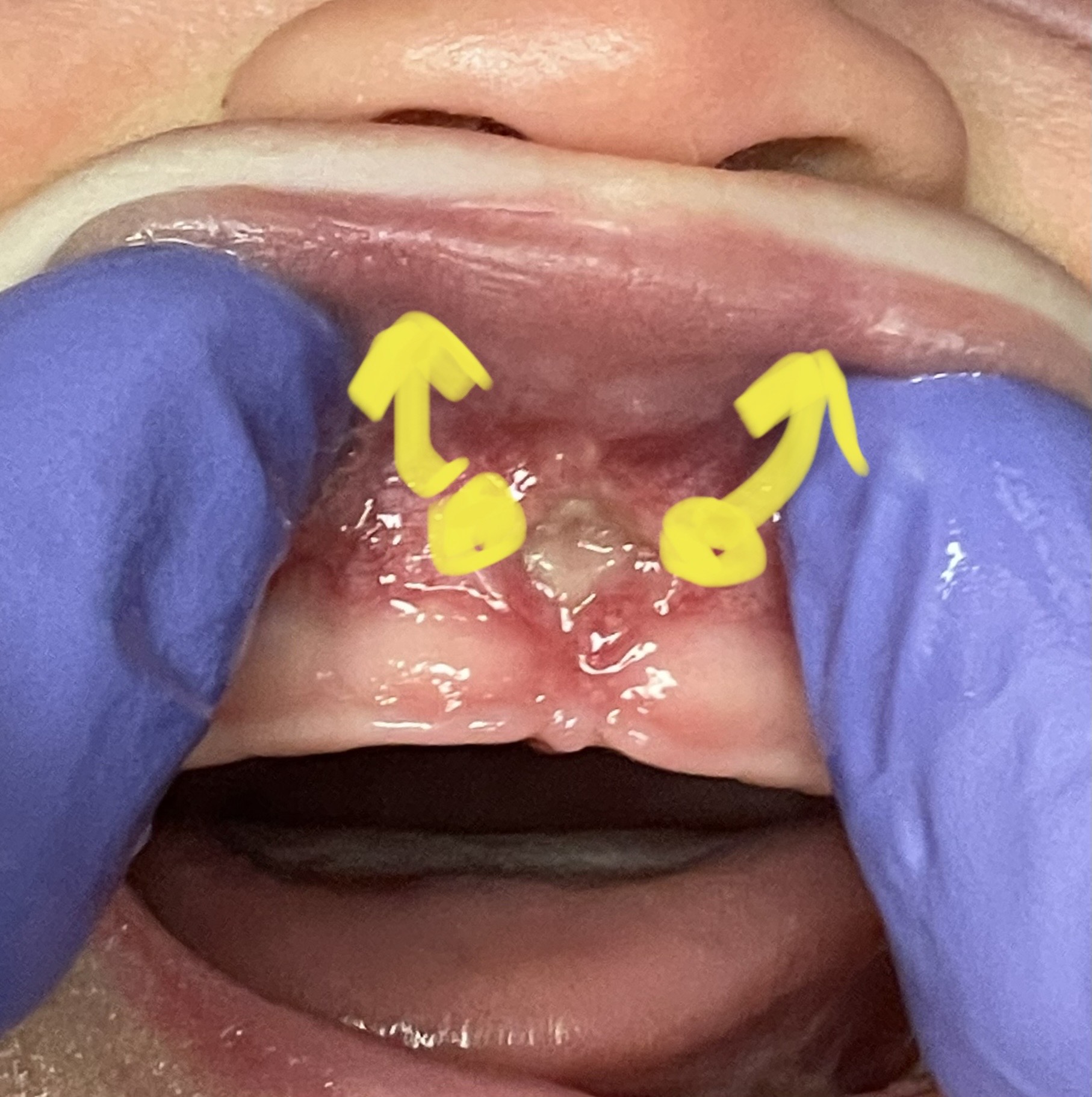 Lip-Tie Release Lip-Tie Release