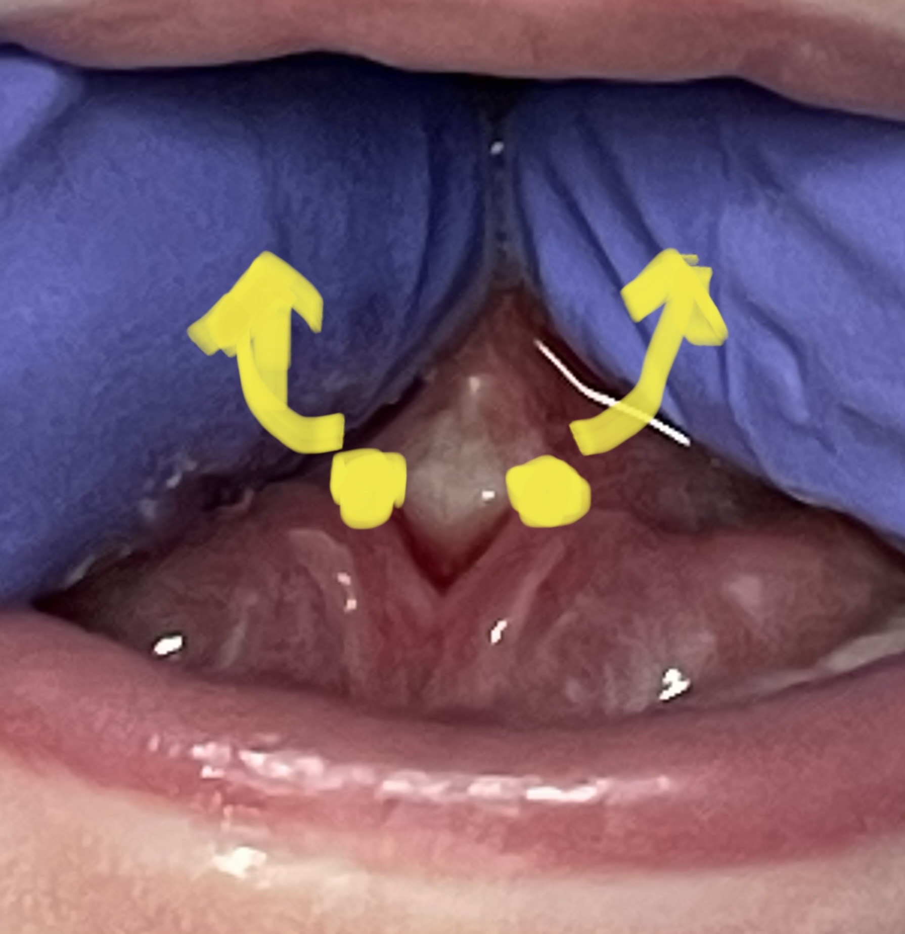 Tongue-Tie Release Tongue-Tie Release